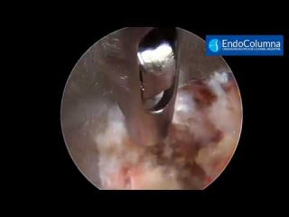 Foraminotom&iacute;a cervical UBE