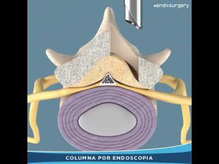 T&eacute;cnica UBE: Unilateral Biportal Endosc&oacute;pico. Cirug&iacute;a descompresiva para canal estrecho lumbar o hernia de disco