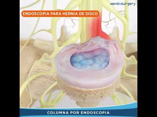 Cirug&iacute;a Endosc&oacute;pica para Hernia de Disco. Discectom&iacute;a endosc&oacute;pica v&iacute;a transforminal e interlaminar