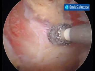 Endoscop&iacute;a