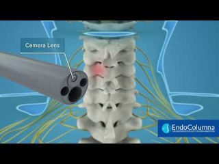 Endoscop&iacute;a Cervical